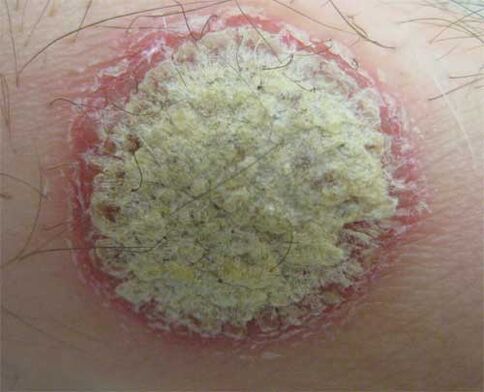 Triasis